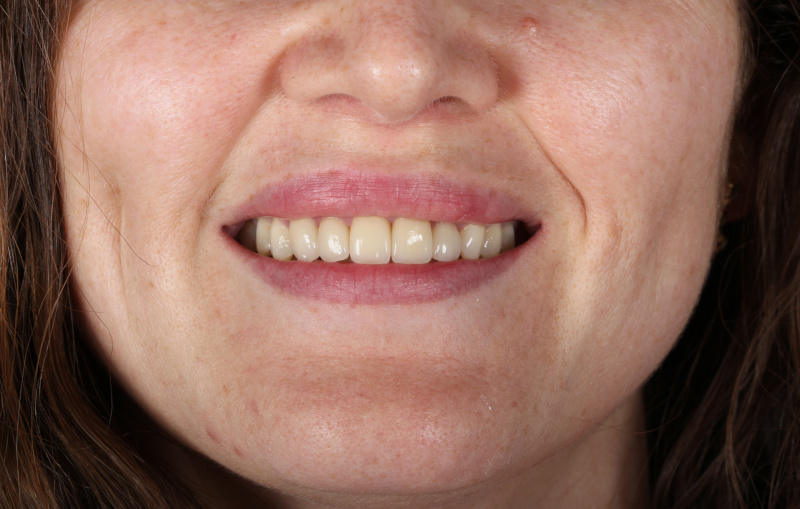 Active Aligners - my teeth after treatment.