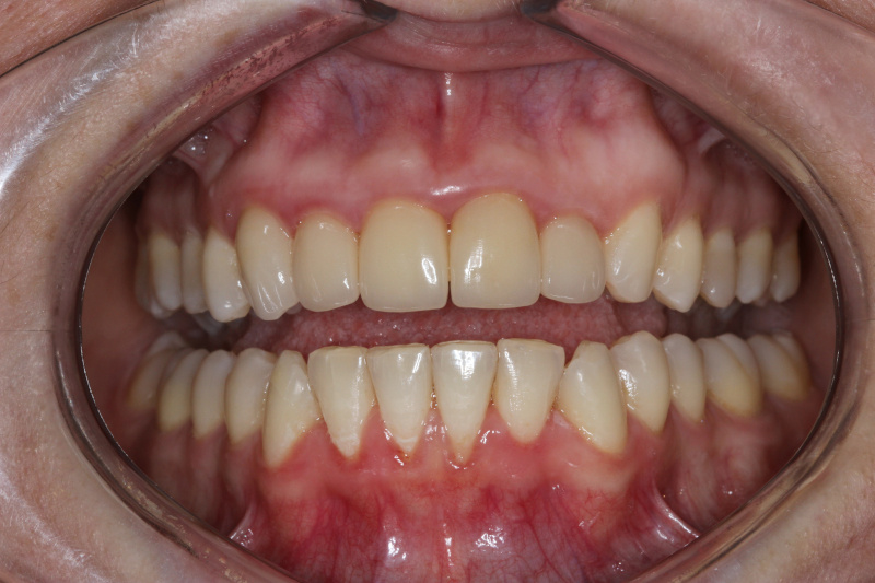 Active Aligners - my teeth before treatment.